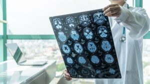 Puoi ottenere una commozione cerebrale senza colpire la testa?