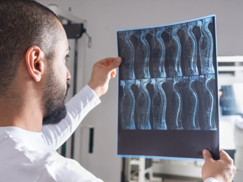 ​How Much Is Your Spinal Cord Injury Case Worth if You’re a Paraplegic?